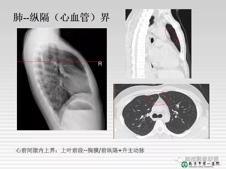 【PPT】胸片中的界与线——识别隐匿者与伪装者