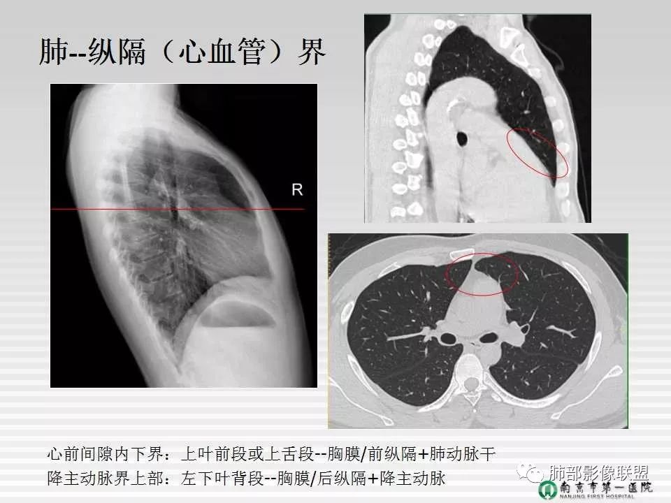 【PPT】胸片中的界与线——识别隐匿者与伪装者