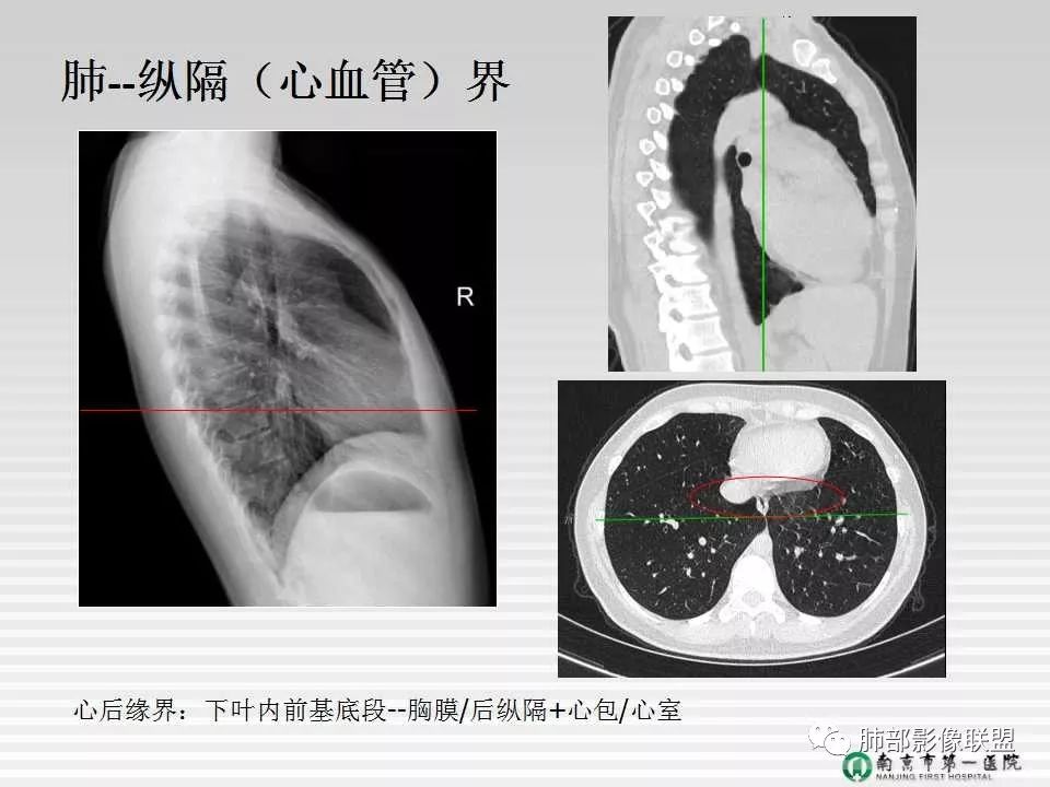 【PPT】胸片中的界与线——识别隐匿者与伪装者