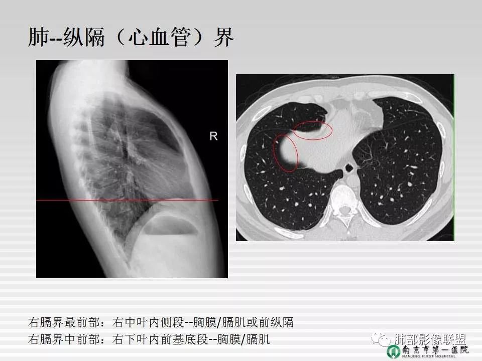 【PPT】胸片中的界与线——识别隐匿者与伪装者
