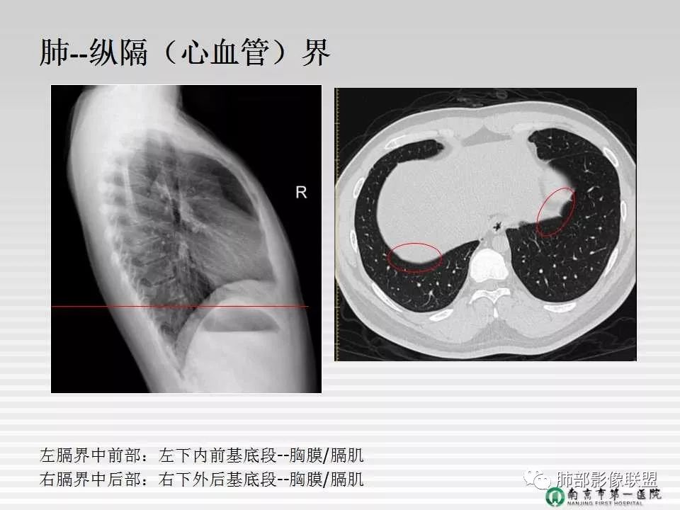【PPT】胸片中的界与线——识别隐匿者与伪装者