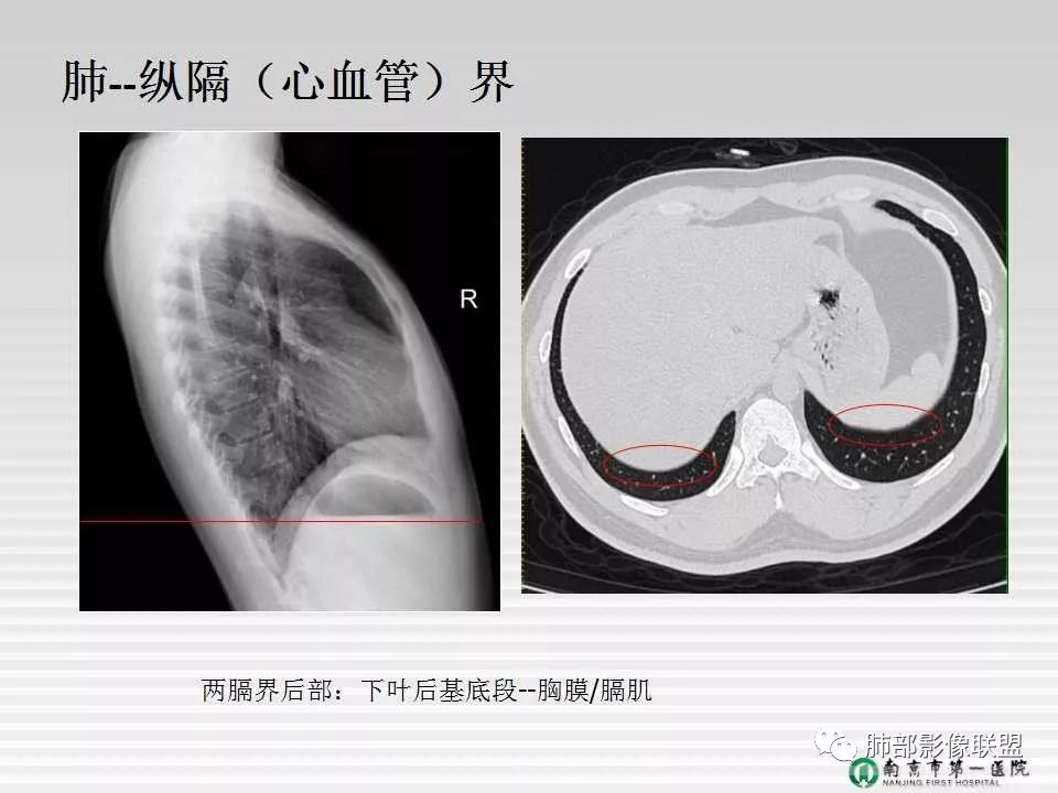 【PPT】胸片中的界与线——识别隐匿者与伪装者