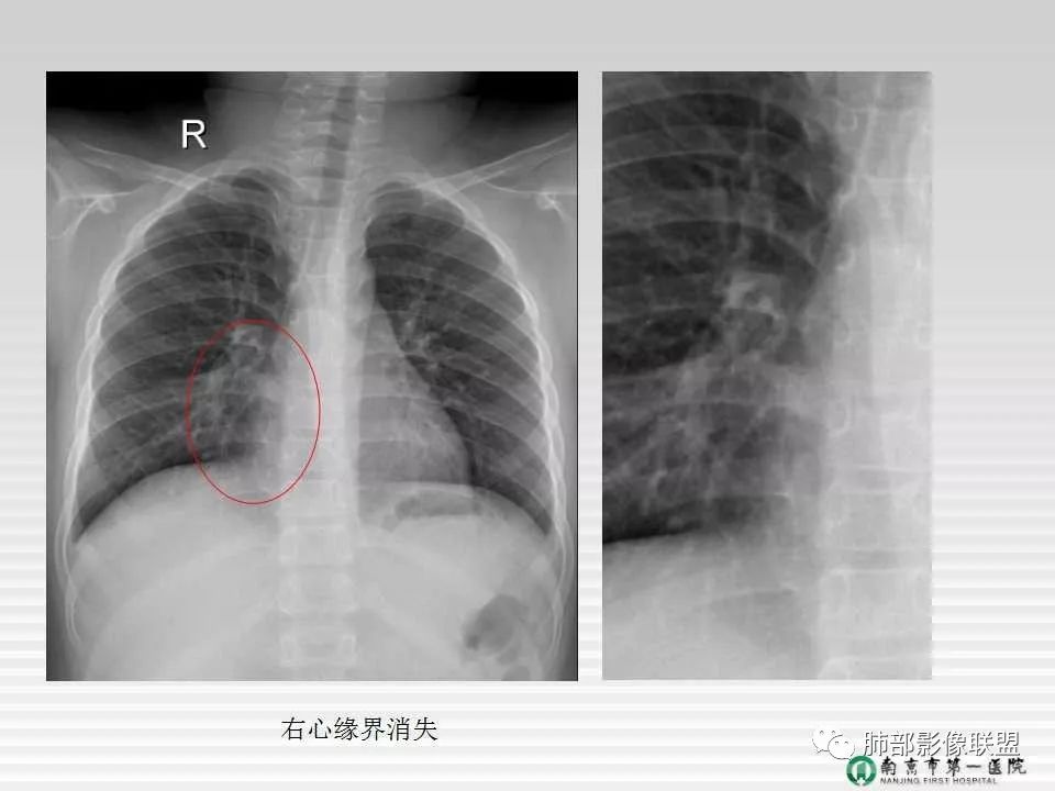 【PPT】胸片中的界与线——识别隐匿者与伪装者