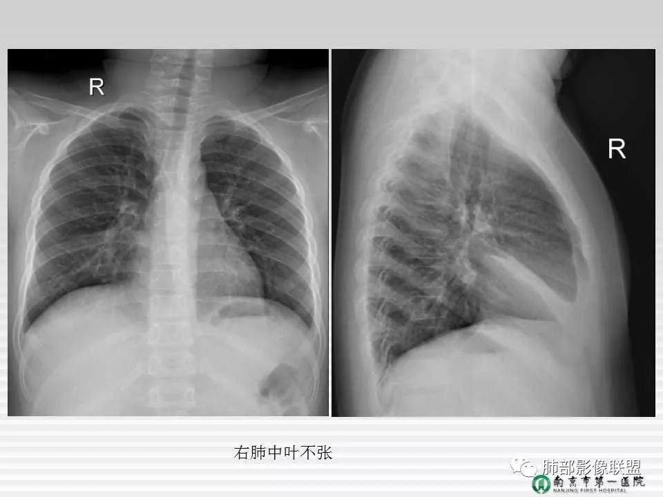 【PPT】胸片中的界与线——识别隐匿者与伪装者