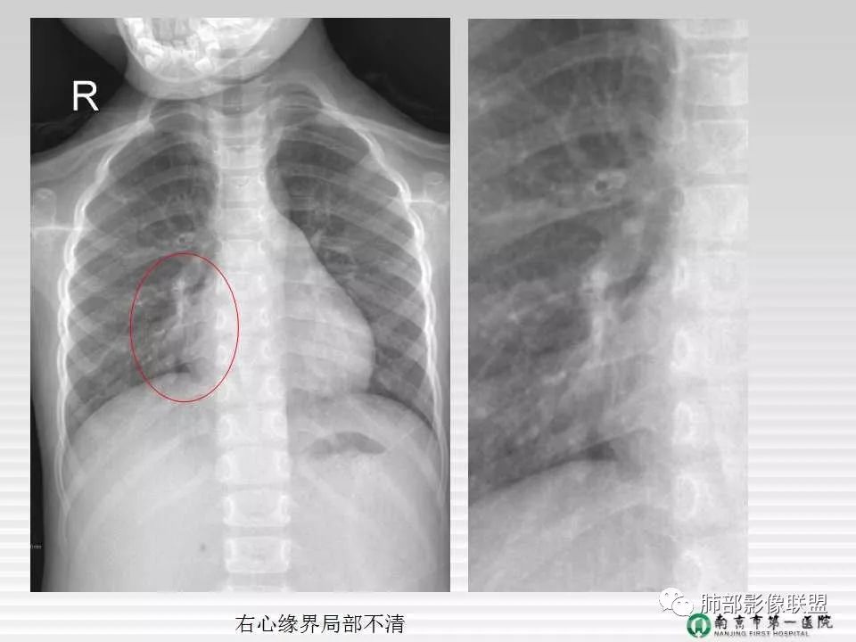 【PPT】胸片中的界与线——识别隐匿者与伪装者