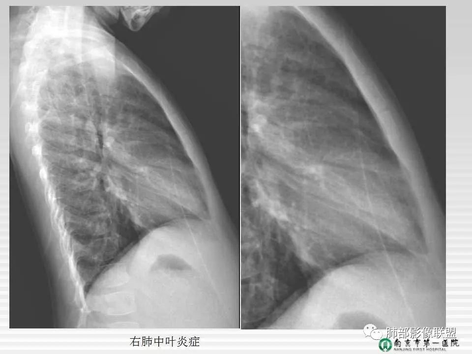 【PPT】胸片中的界与线——识别隐匿者与伪装者