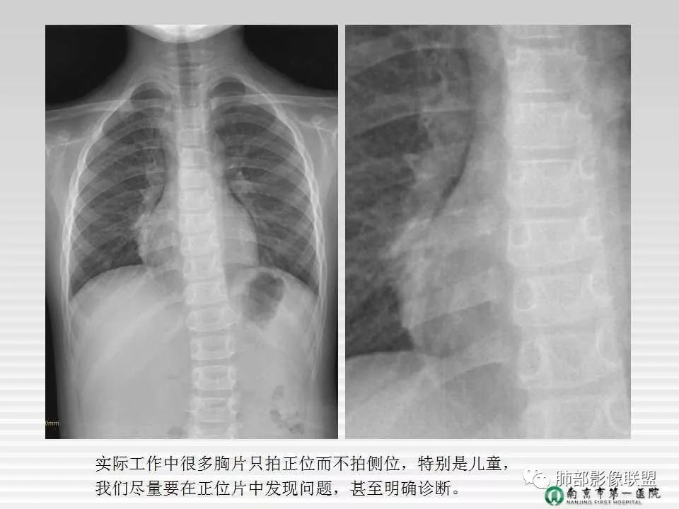【PPT】胸片中的界与线——识别隐匿者与伪装者