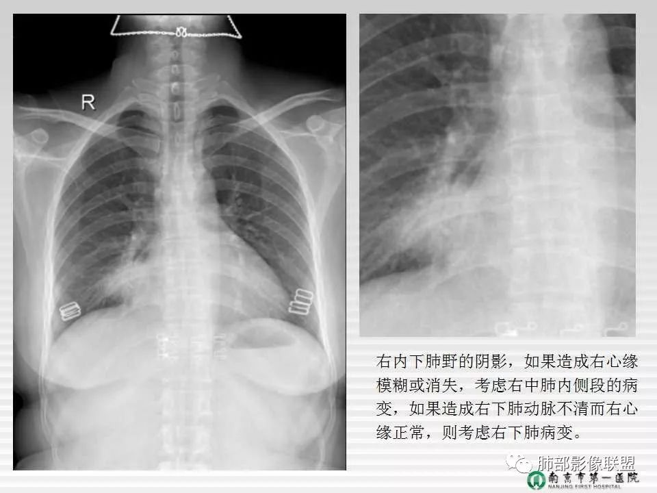 【PPT】胸片中的界与线——识别隐匿者与伪装者