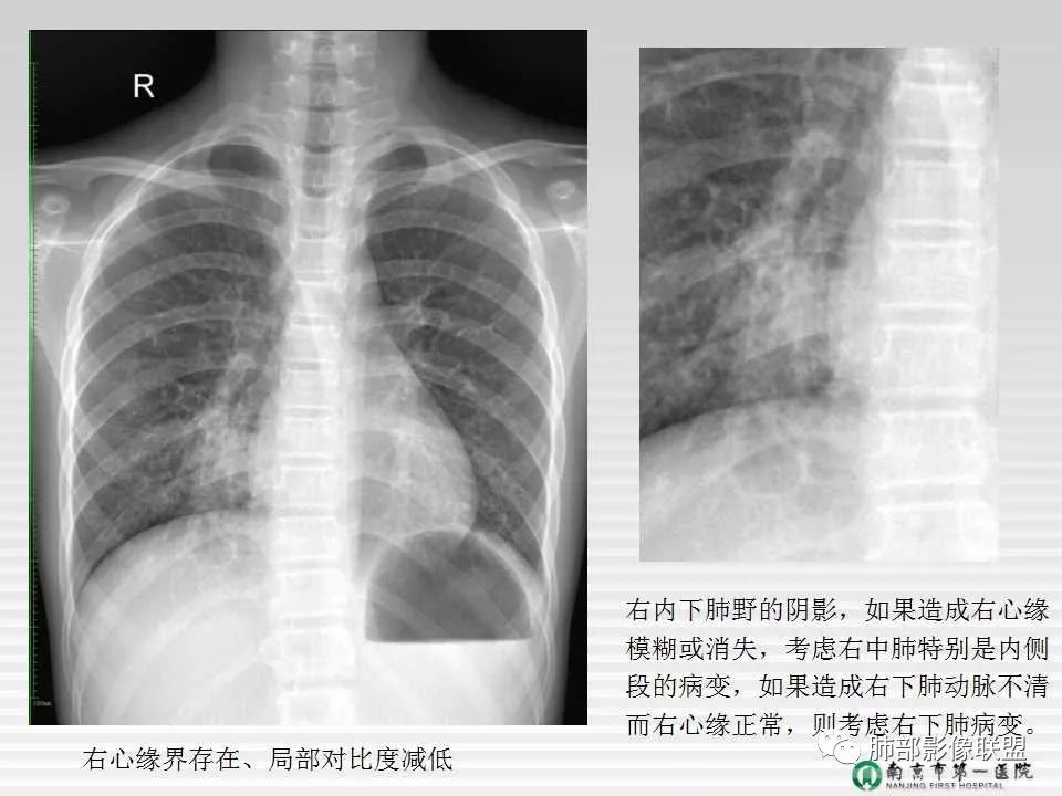 【PPT】胸片中的界与线——识别隐匿者与伪装者