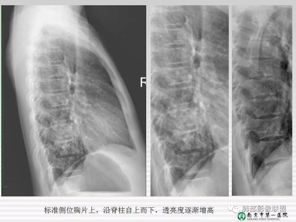 【PPT】胸片中的界与线——识别隐匿者与伪装者