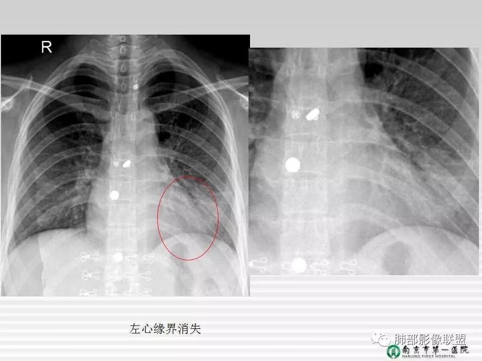 【PPT】胸片中的界与线——识别隐匿者与伪装者