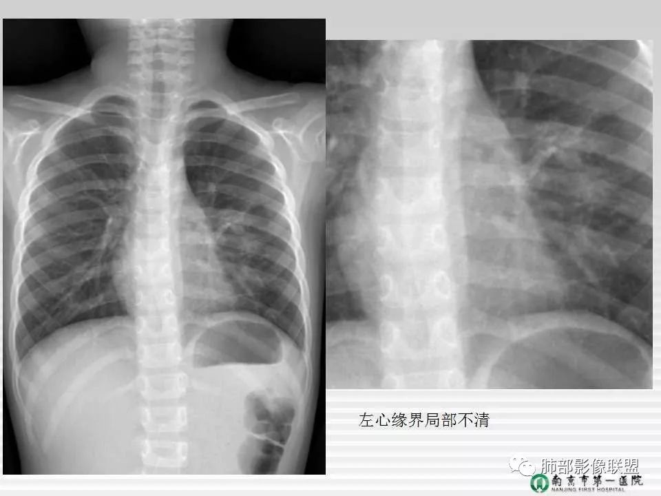 【PPT】胸片中的界与线——识别隐匿者与伪装者