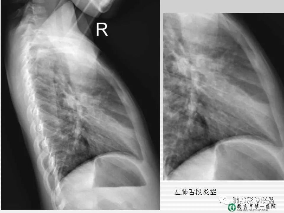 【PPT】胸片中的界与线——识别隐匿者与伪装者