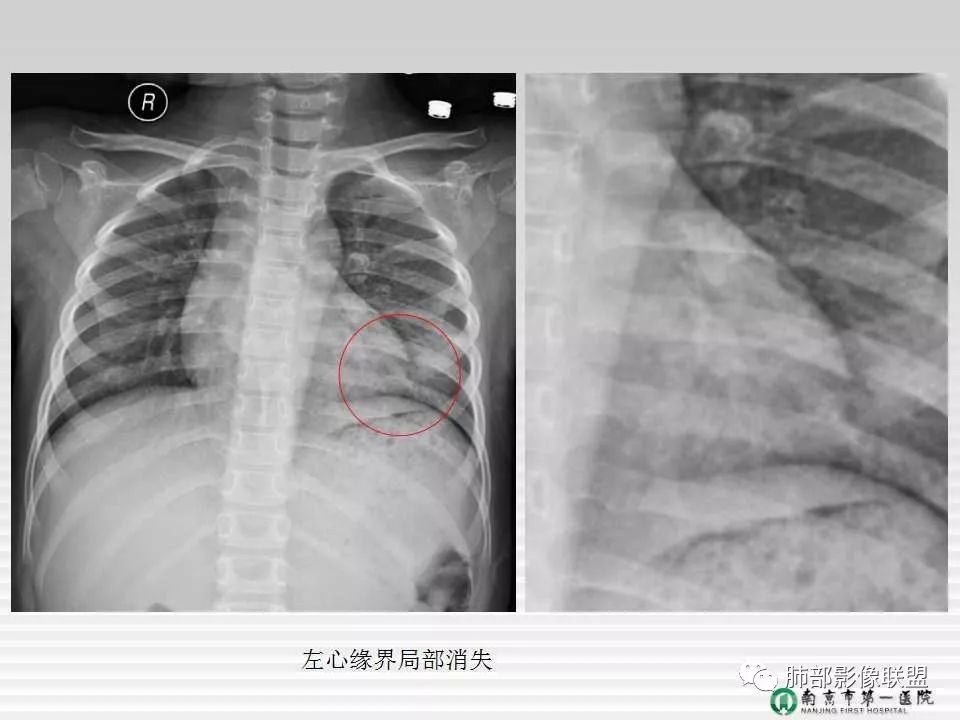 【PPT】胸片中的界与线——识别隐匿者与伪装者