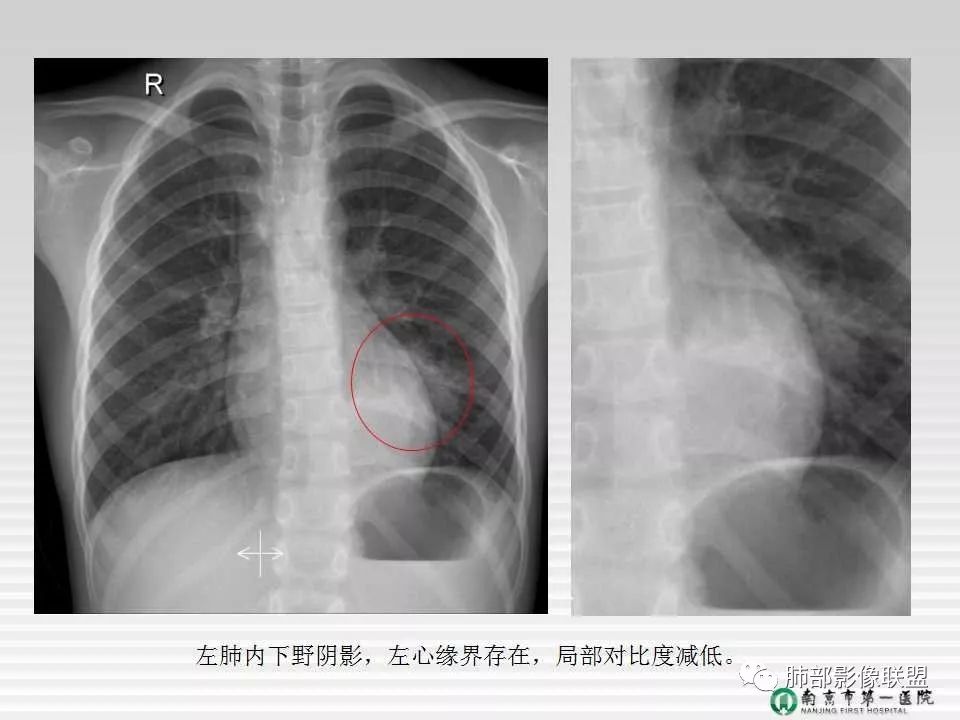 【PPT】胸片中的界与线——识别隐匿者与伪装者