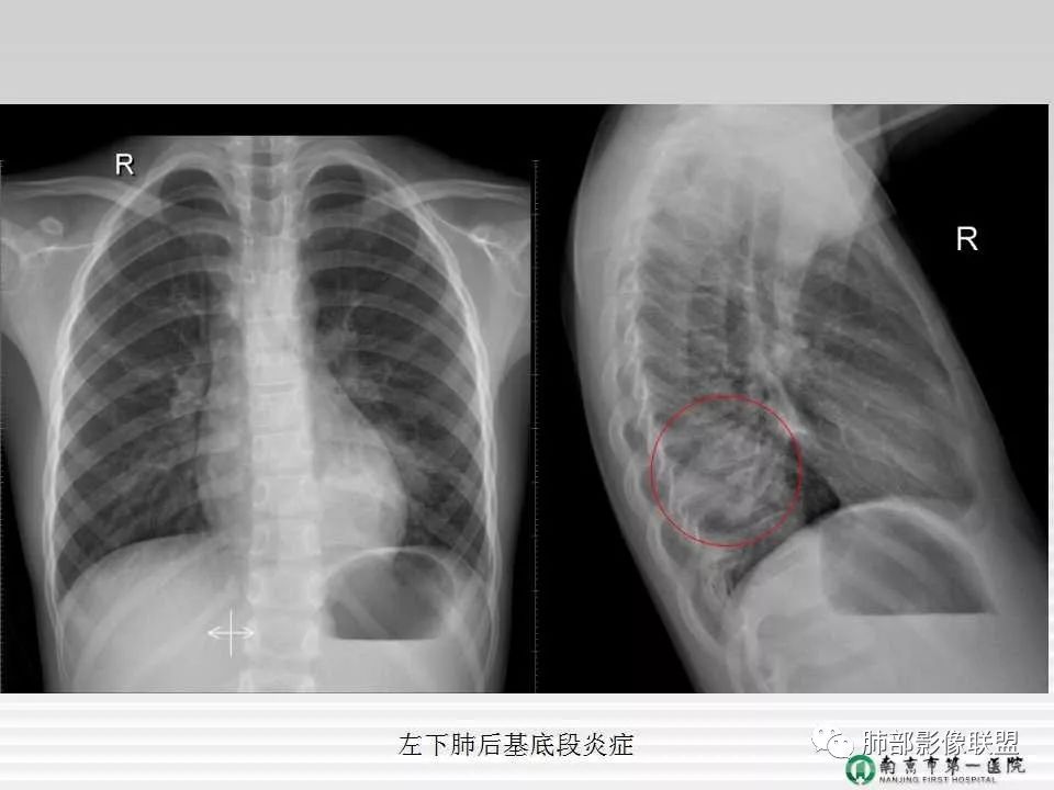 【PPT】胸片中的界与线——识别隐匿者与伪装者