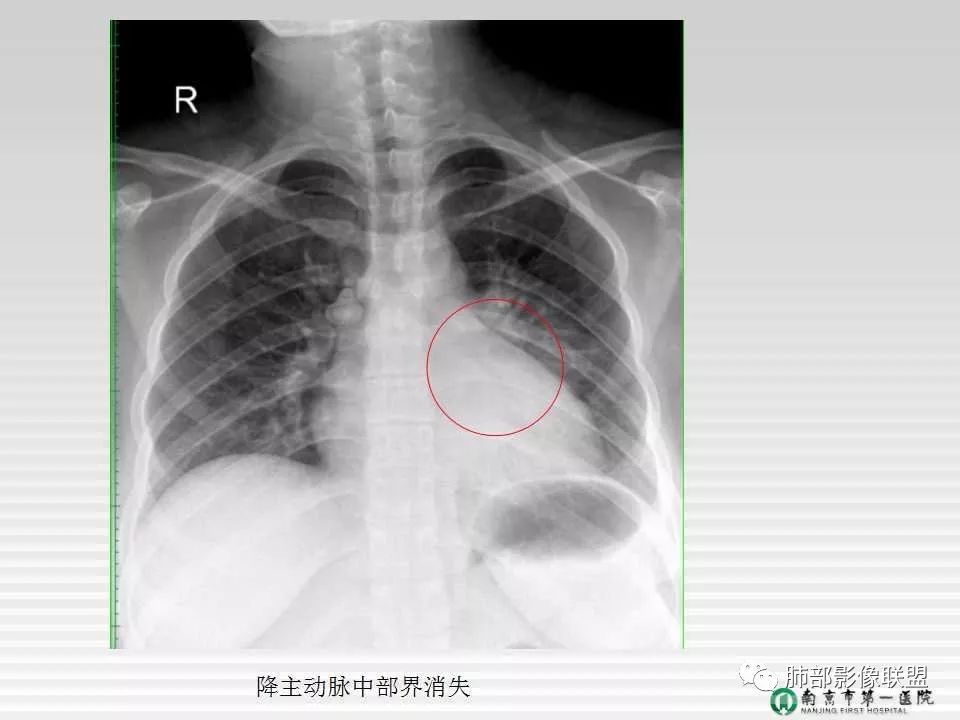 【PPT】胸片中的界与线——识别隐匿者与伪装者