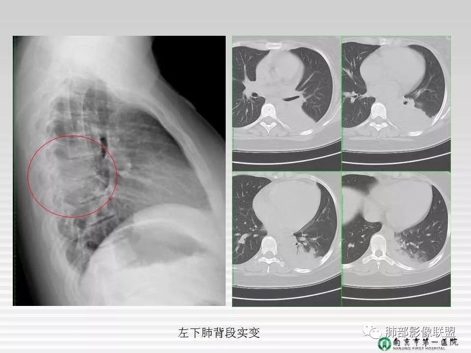 【PPT】胸片中的界与线——识别隐匿者与伪装者