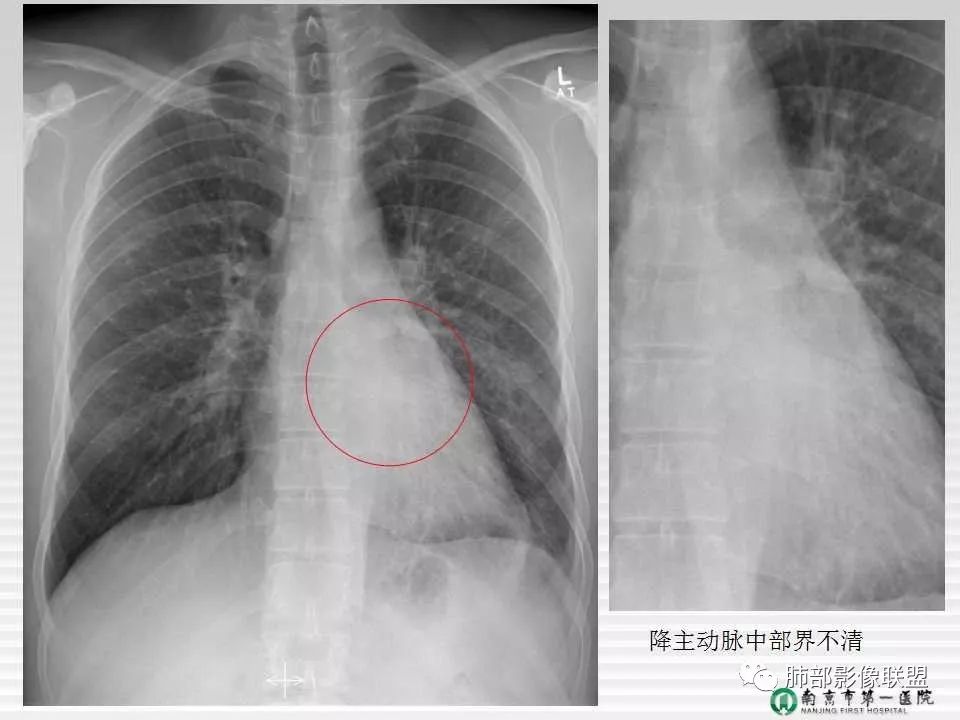 【PPT】胸片中的界与线——识别隐匿者与伪装者