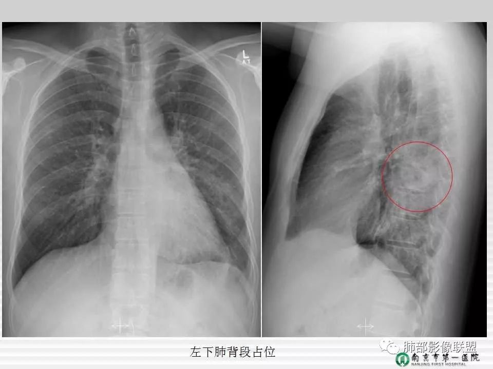 【PPT】胸片中的界与线——识别隐匿者与伪装者