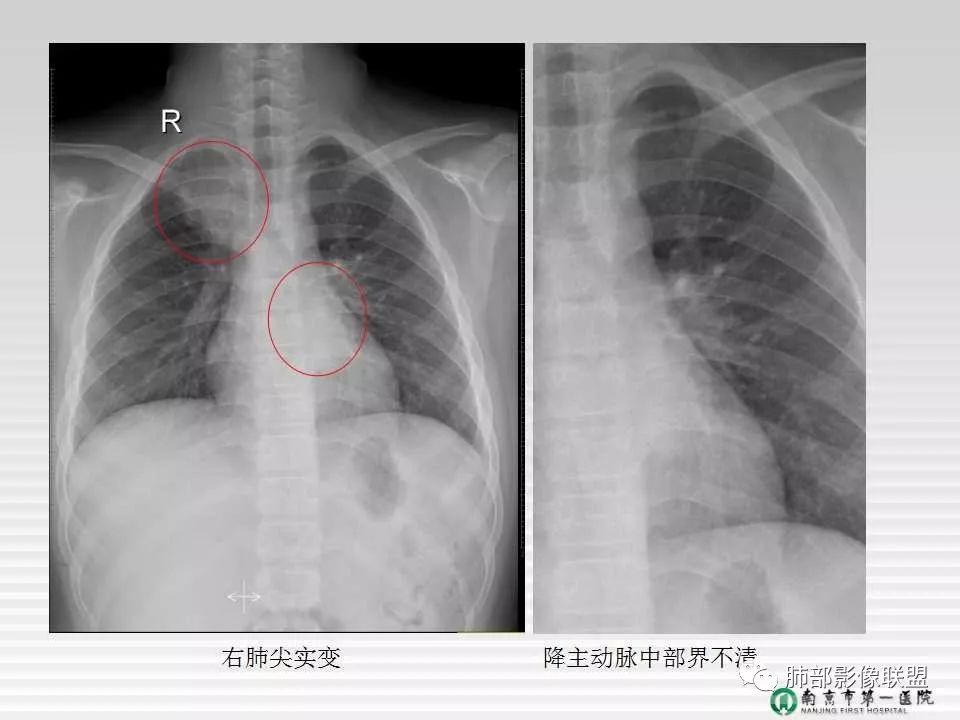 【PPT】胸片中的界与线——识别隐匿者与伪装者
