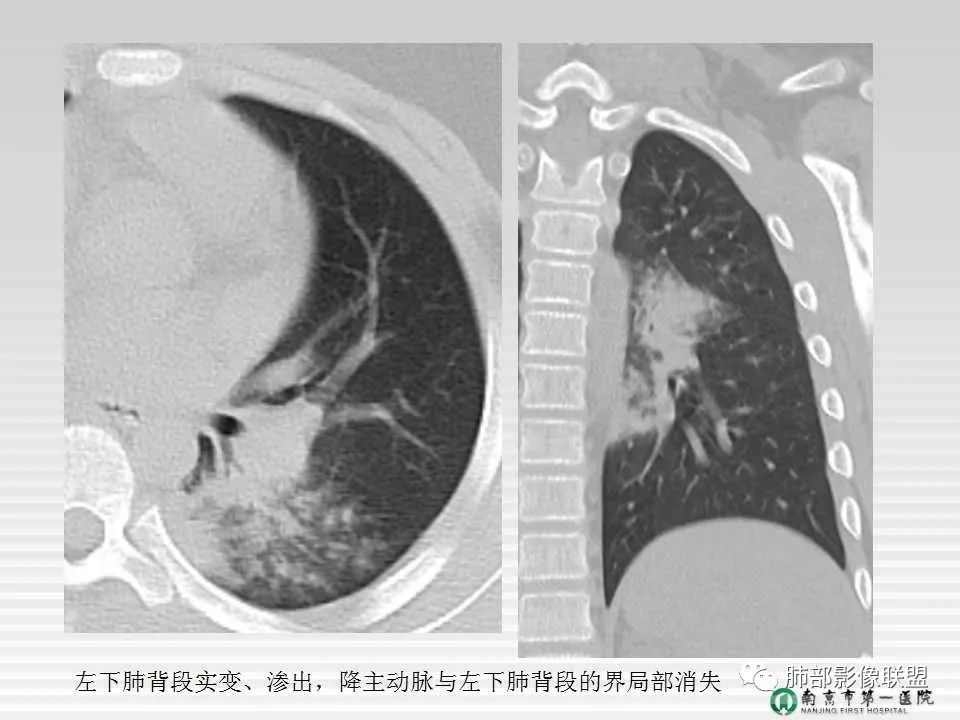 【PPT】胸片中的界与线——识别隐匿者与伪装者