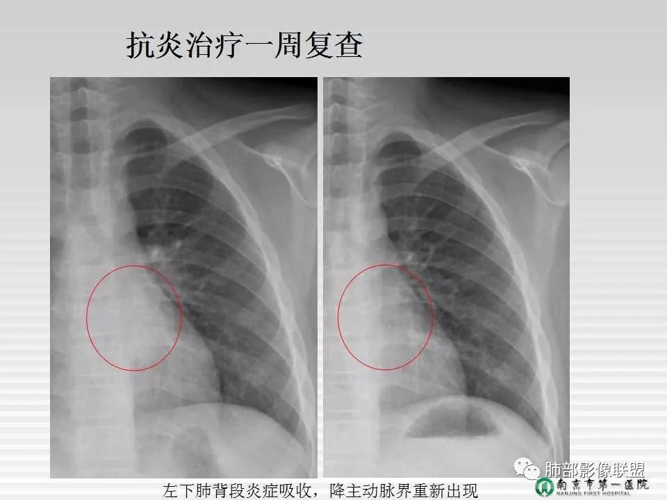 【PPT】胸片中的界与线——识别隐匿者与伪装者