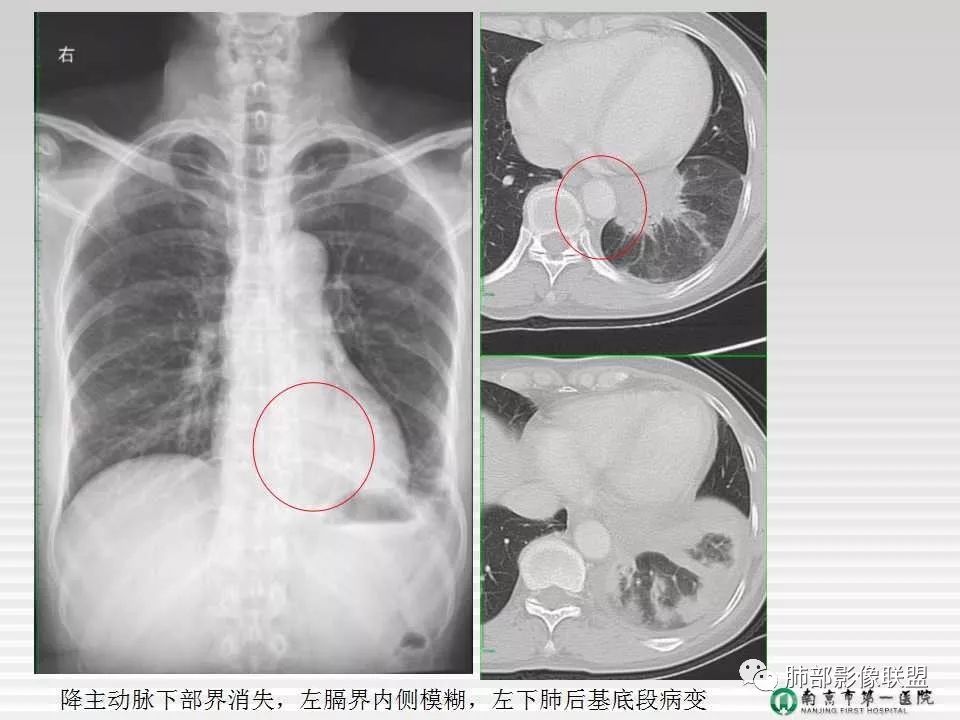【PPT】胸片中的界与线——识别隐匿者与伪装者
