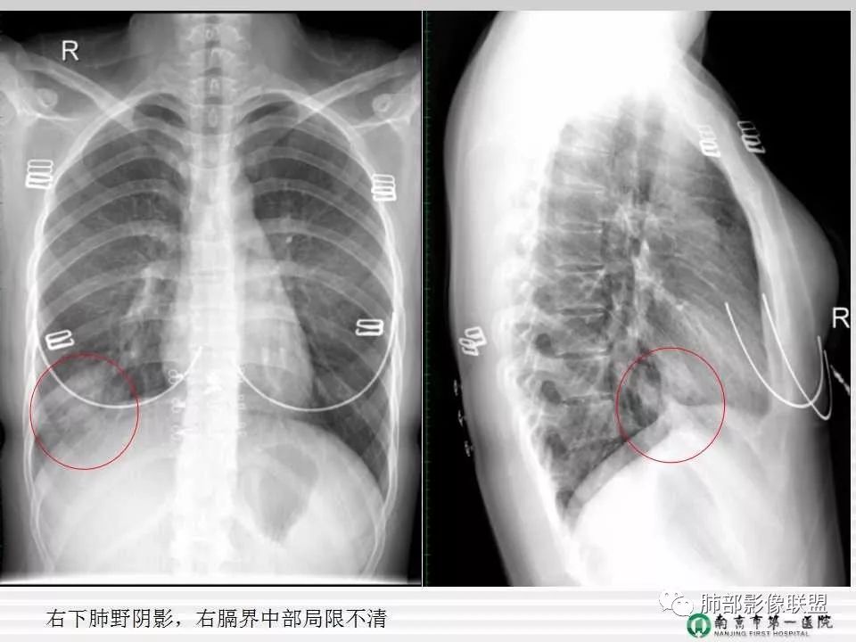 【PPT】胸片中的界与线——识别隐匿者与伪装者
