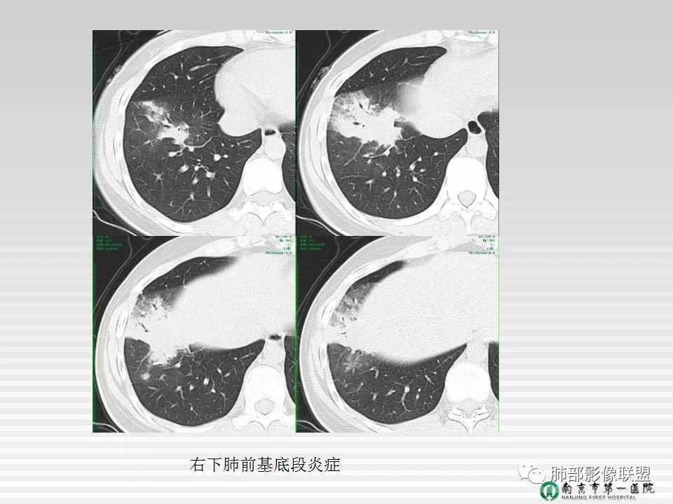【PPT】胸片中的界与线——识别隐匿者与伪装者