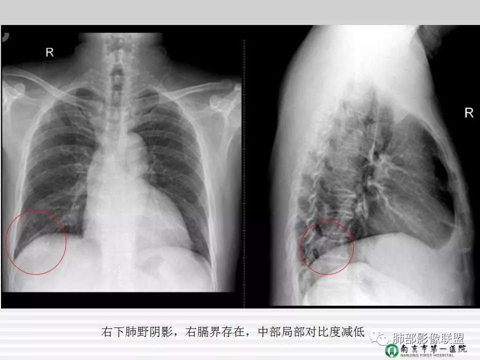 【PPT】胸片中的界与线——识别隐匿者与伪装者