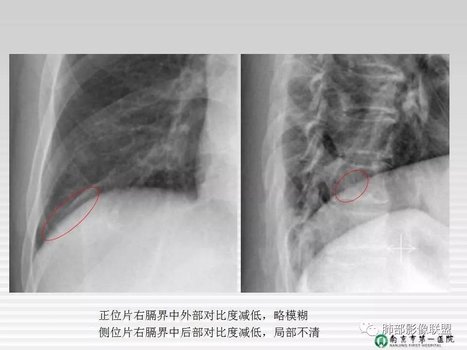 【PPT】胸片中的界与线——识别隐匿者与伪装者