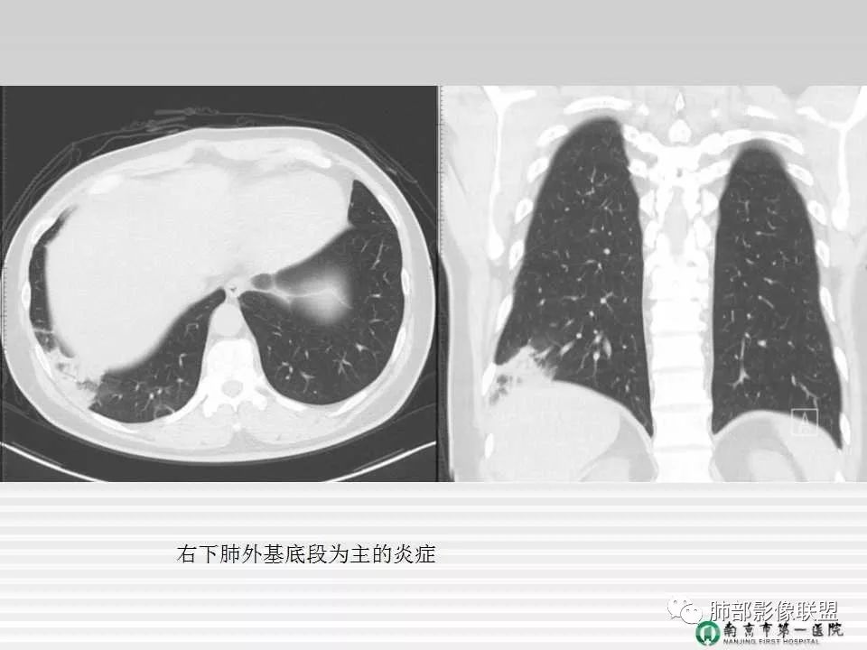【PPT】胸片中的界与线——识别隐匿者与伪装者