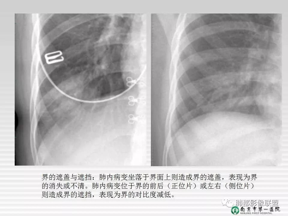 【PPT】胸片中的界与线——识别隐匿者与伪装者
