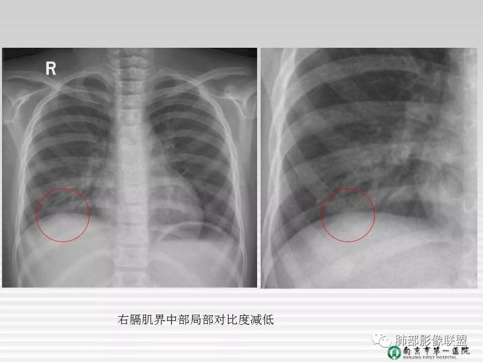 【PPT】胸片中的界与线——识别隐匿者与伪装者
