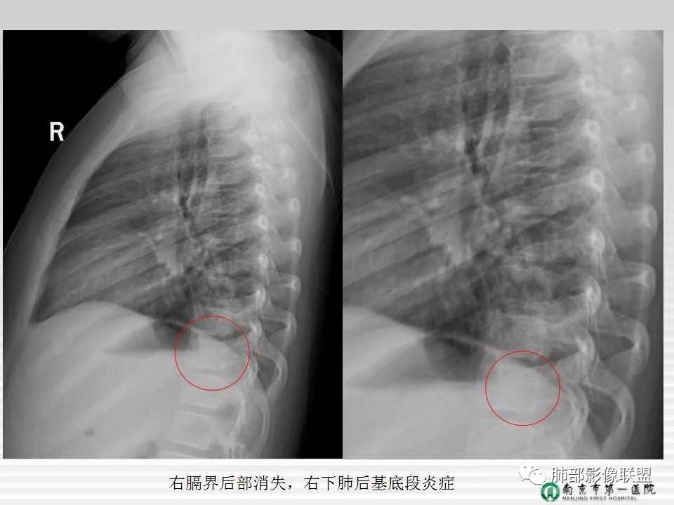 【PPT】胸片中的界与线——识别隐匿者与伪装者