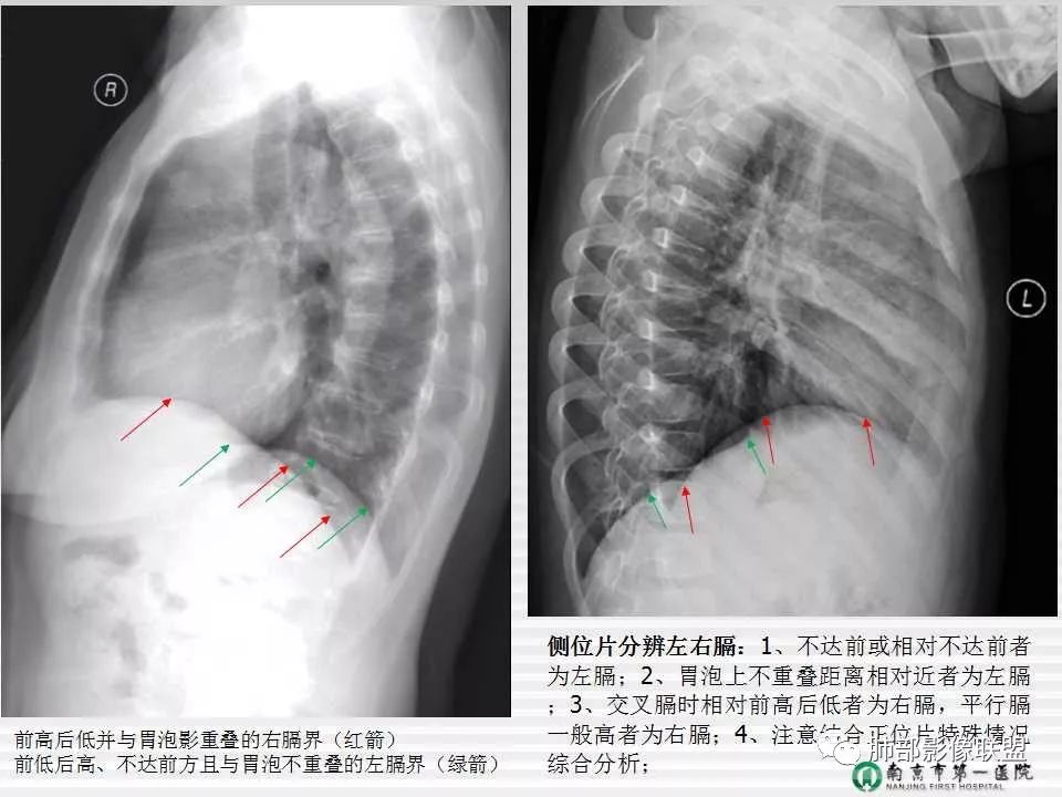 【PPT】胸片中的界与线——识别隐匿者与伪装者