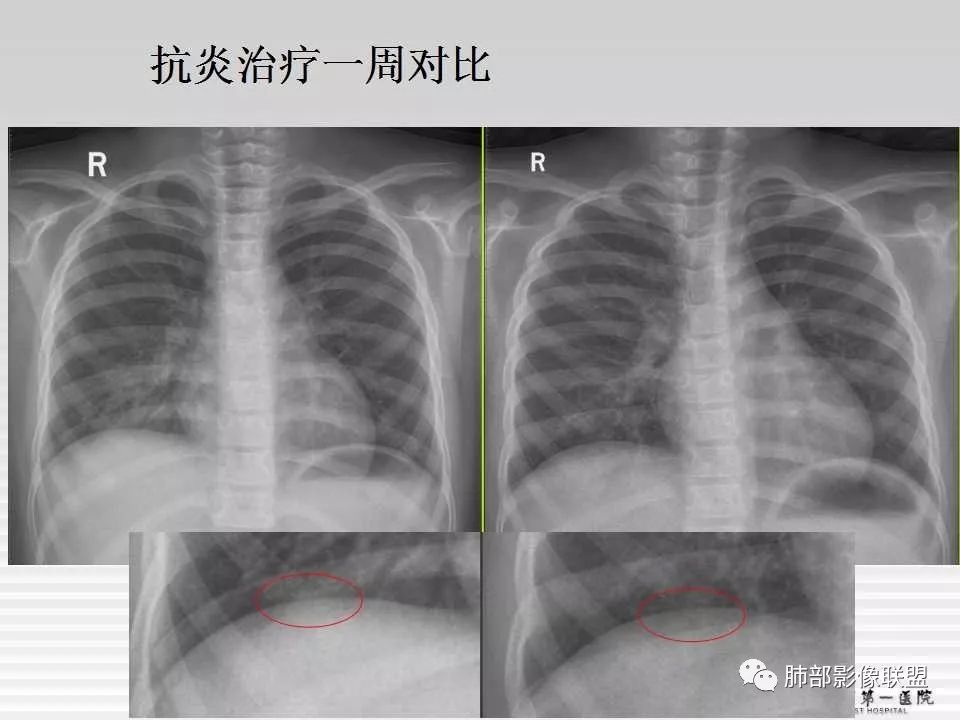 【PPT】胸片中的界与线——识别隐匿者与伪装者