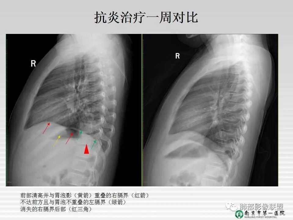【PPT】胸片中的界与线——识别隐匿者与伪装者