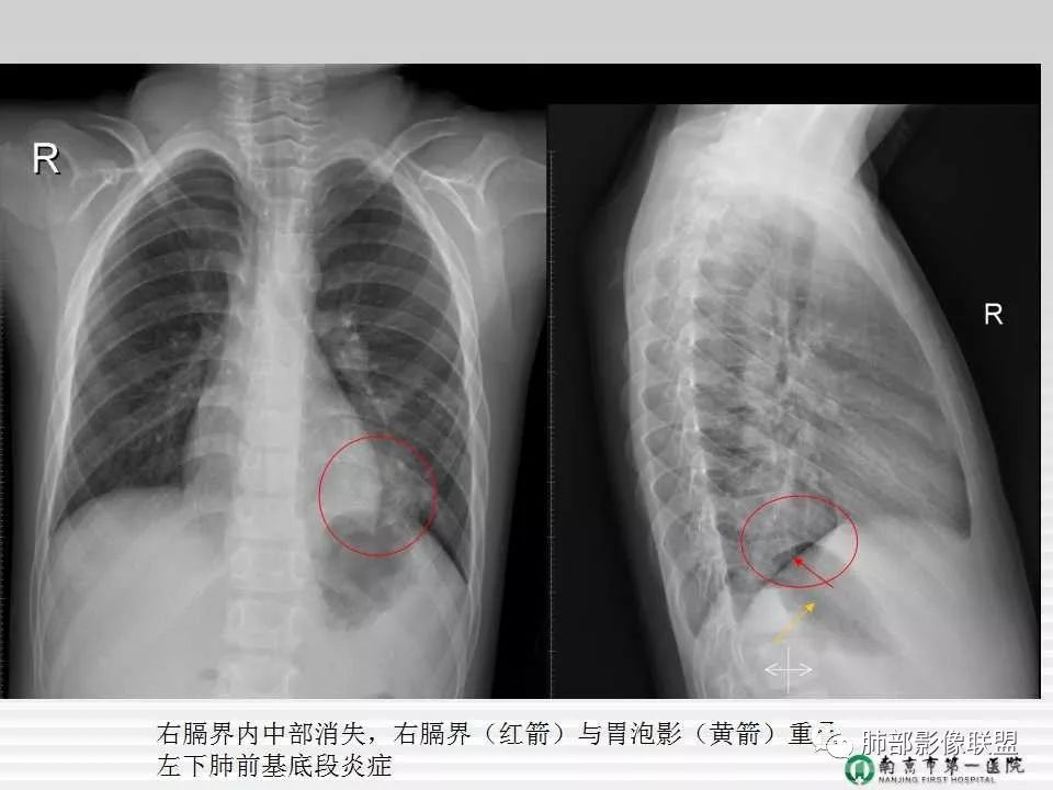 【PPT】胸片中的界与线——识别隐匿者与伪装者