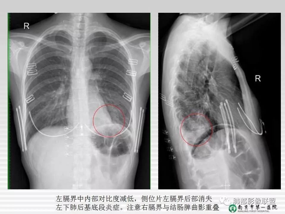 【PPT】胸片中的界与线——识别隐匿者与伪装者