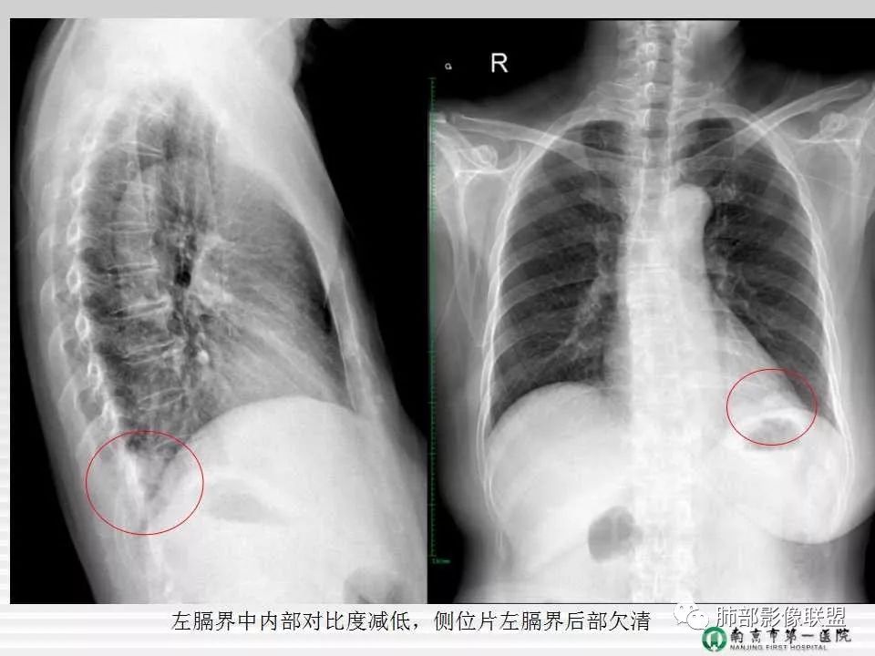 【PPT】胸片中的界与线——识别隐匿者与伪装者