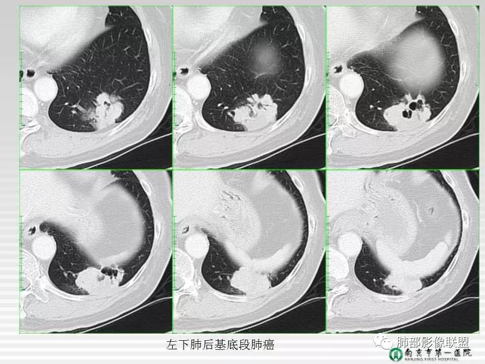 【PPT】胸片中的界与线——识别隐匿者与伪装者