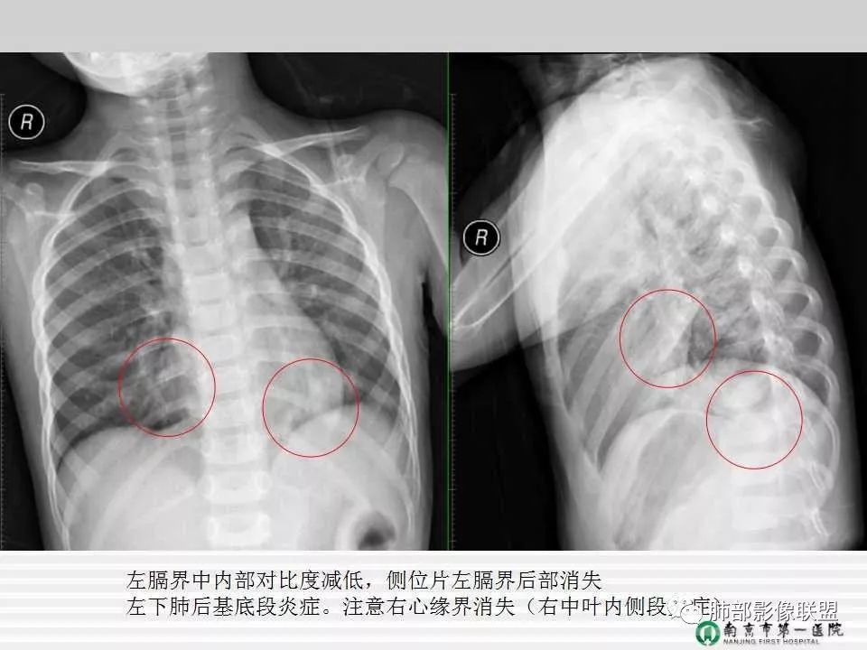【PPT】胸片中的界与线——识别隐匿者与伪装者