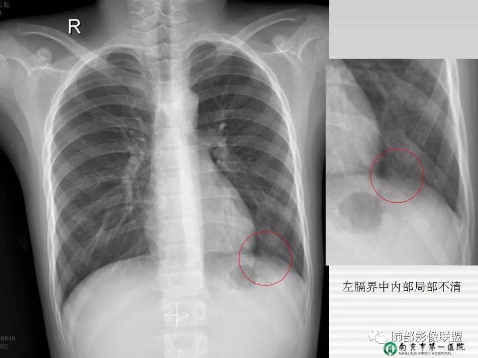【PPT】胸片中的界与线——识别隐匿者与伪装者