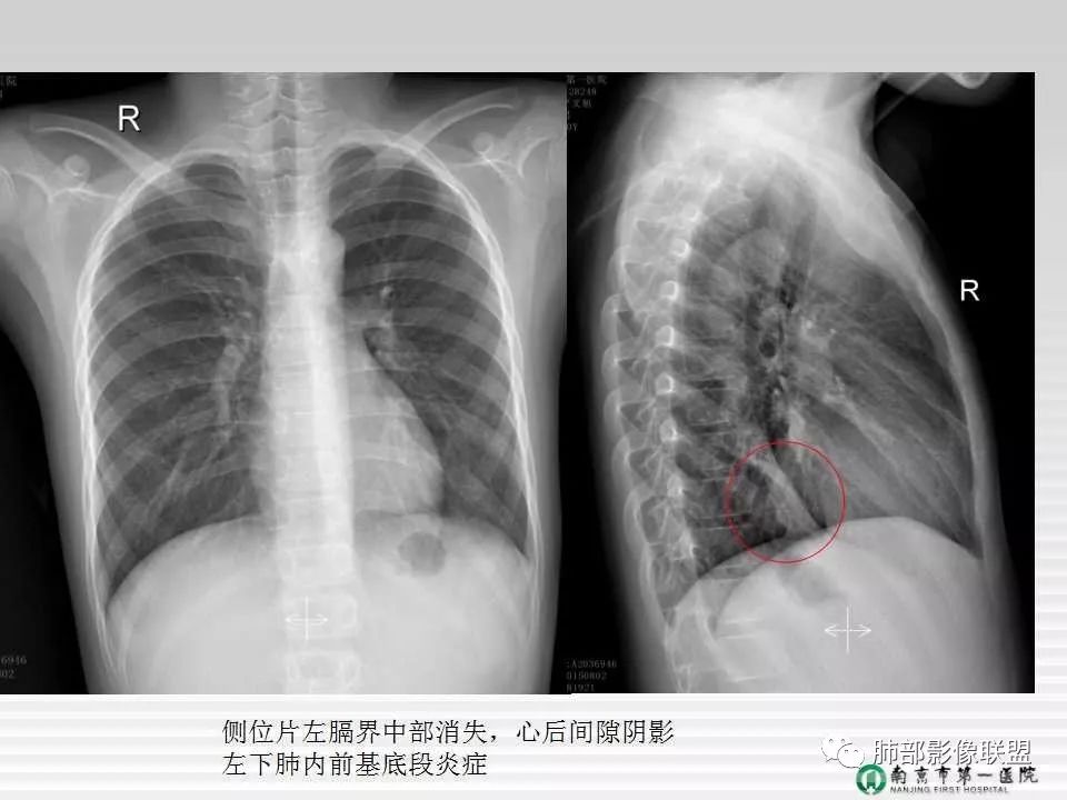 【PPT】胸片中的界与线——识别隐匿者与伪装者