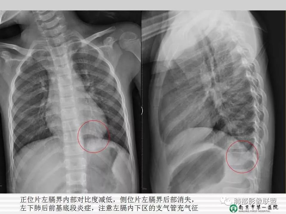 【PPT】胸片中的界与线——识别隐匿者与伪装者