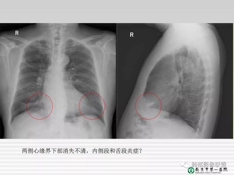 【PPT】胸片中的界与线——识别隐匿者与伪装者