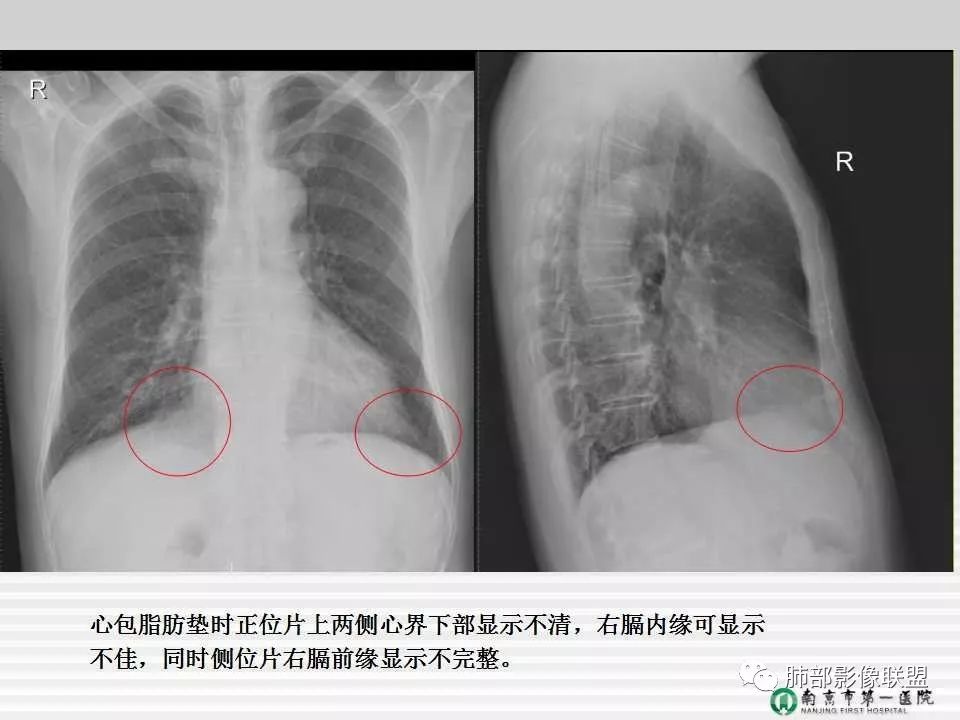 【PPT】胸片中的界与线——识别隐匿者与伪装者