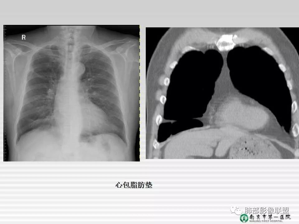 【PPT】胸片中的界与线——识别隐匿者与伪装者